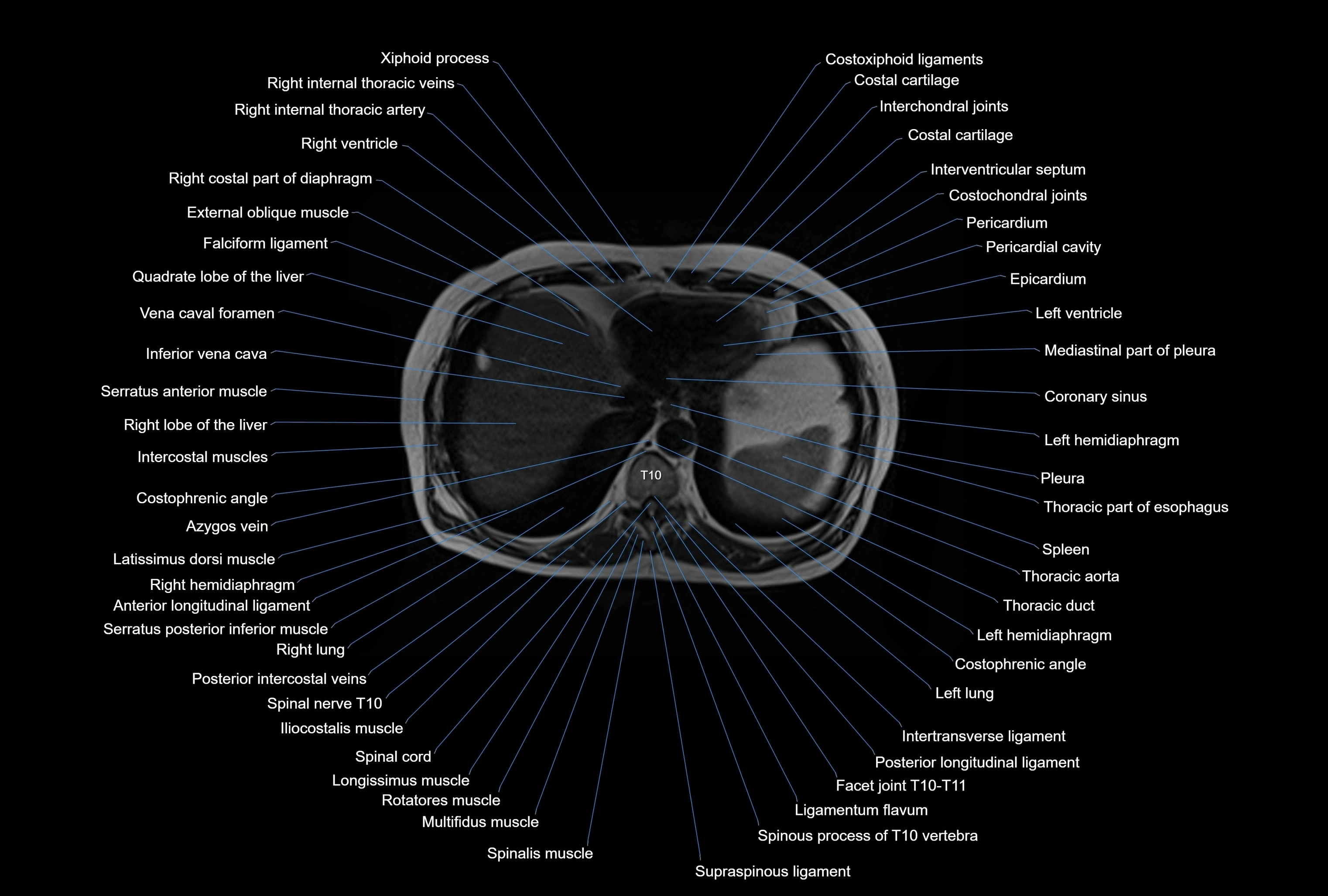 MRI Abdomen axial cross sectional anatomy radiology  image-img-00001-00005.webp